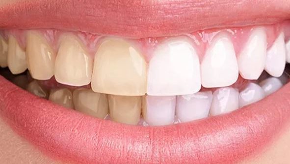 Dental Veneers