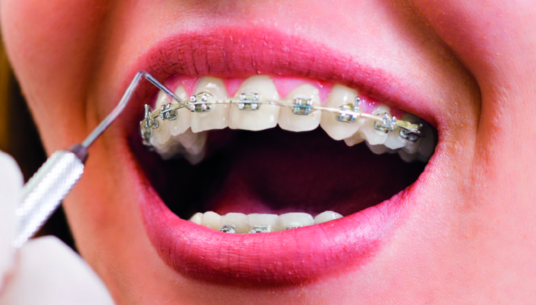 Dental Veneers